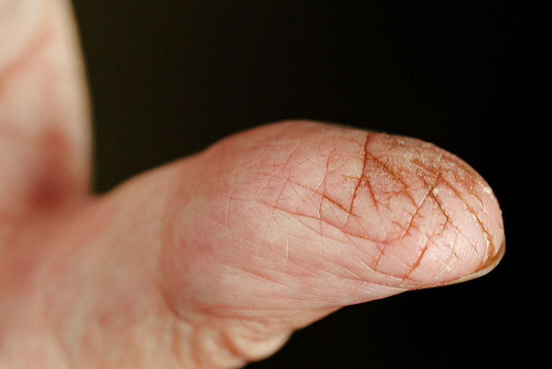 Cracked Skin on Senior Male Thumb