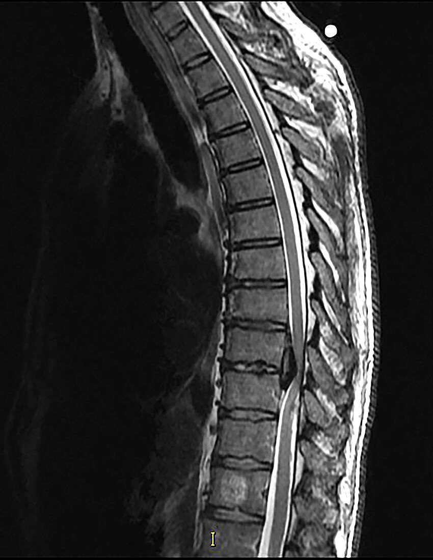 Huge Calcified Thoracic Disc Herniation, MRI