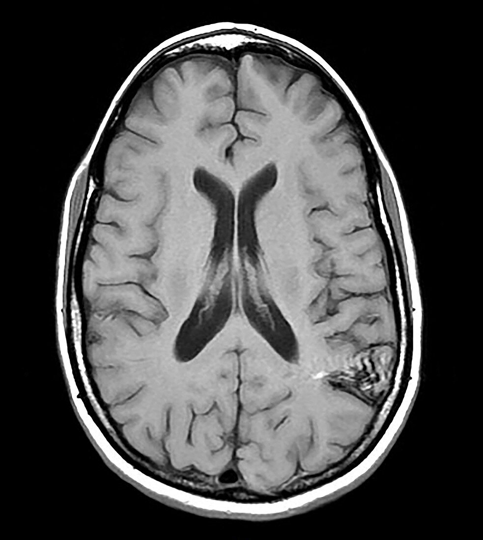Parietal Lobe AVM, MRI