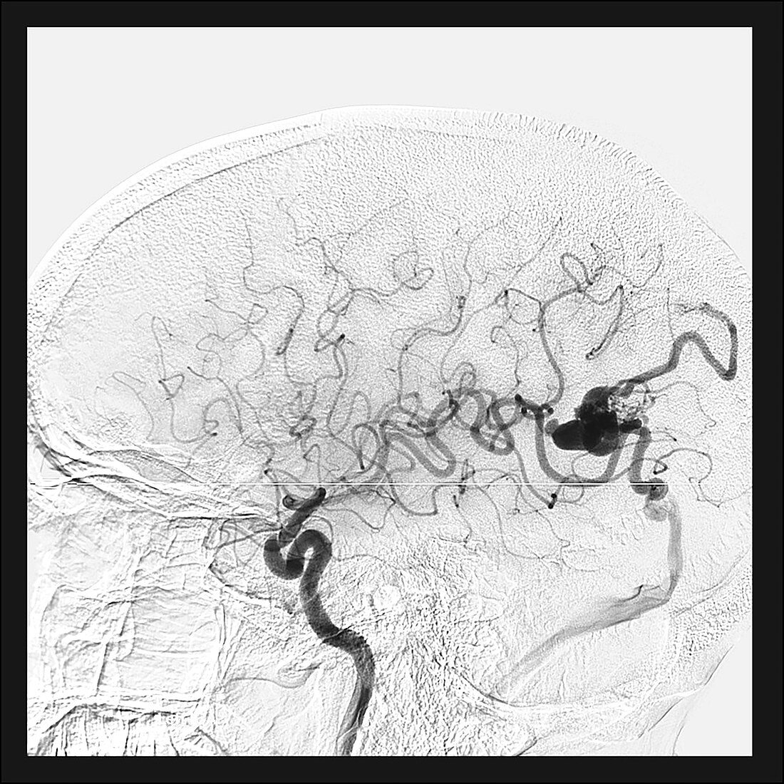 Parietal Lobe AVM, Angiogram