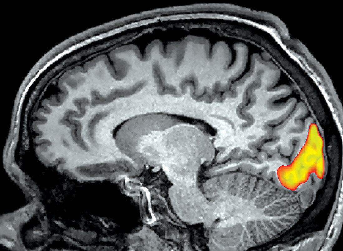 fMRI during Visual Stimulation