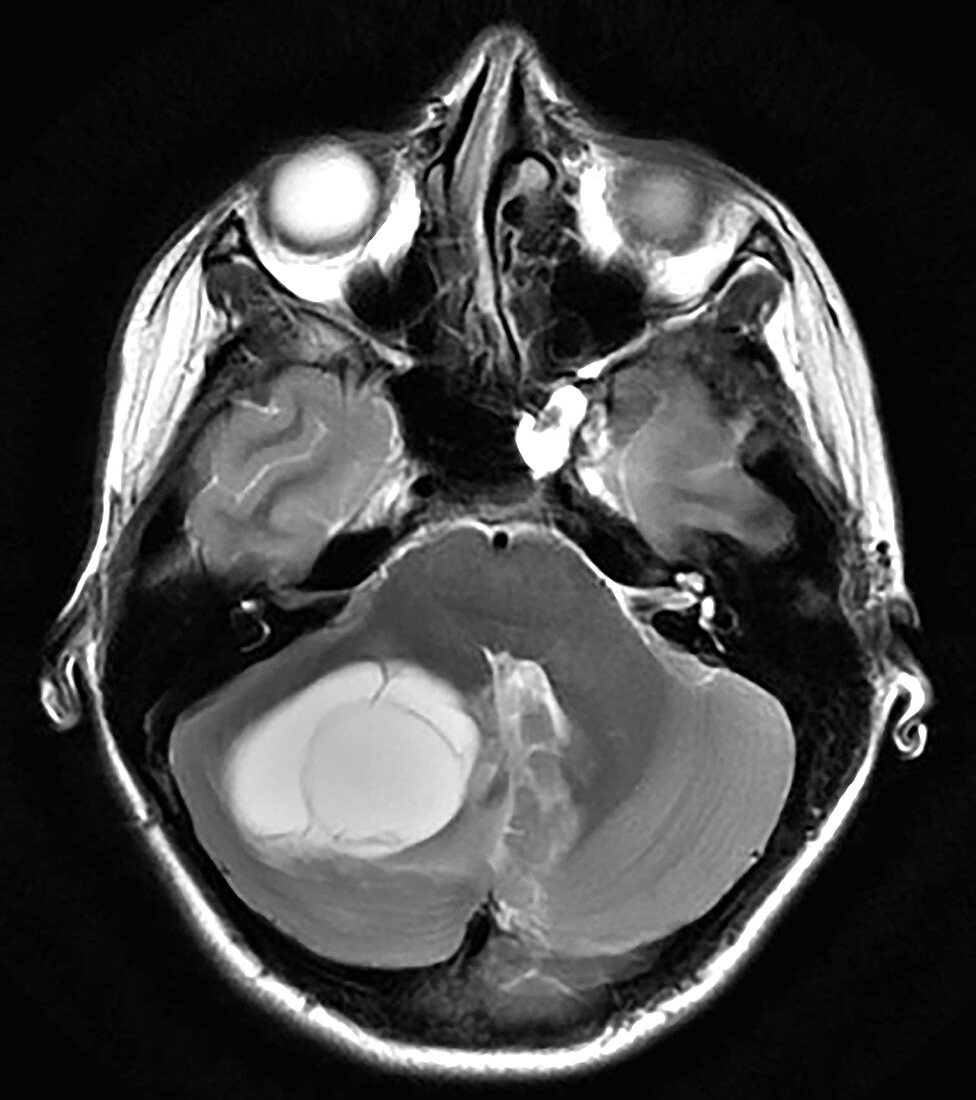 Cerebellar Hemangioblastoma, MRI