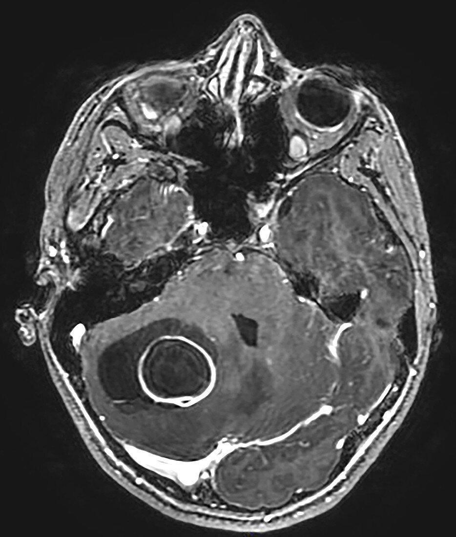 Cerebellar Hemangioblastoma, MRI