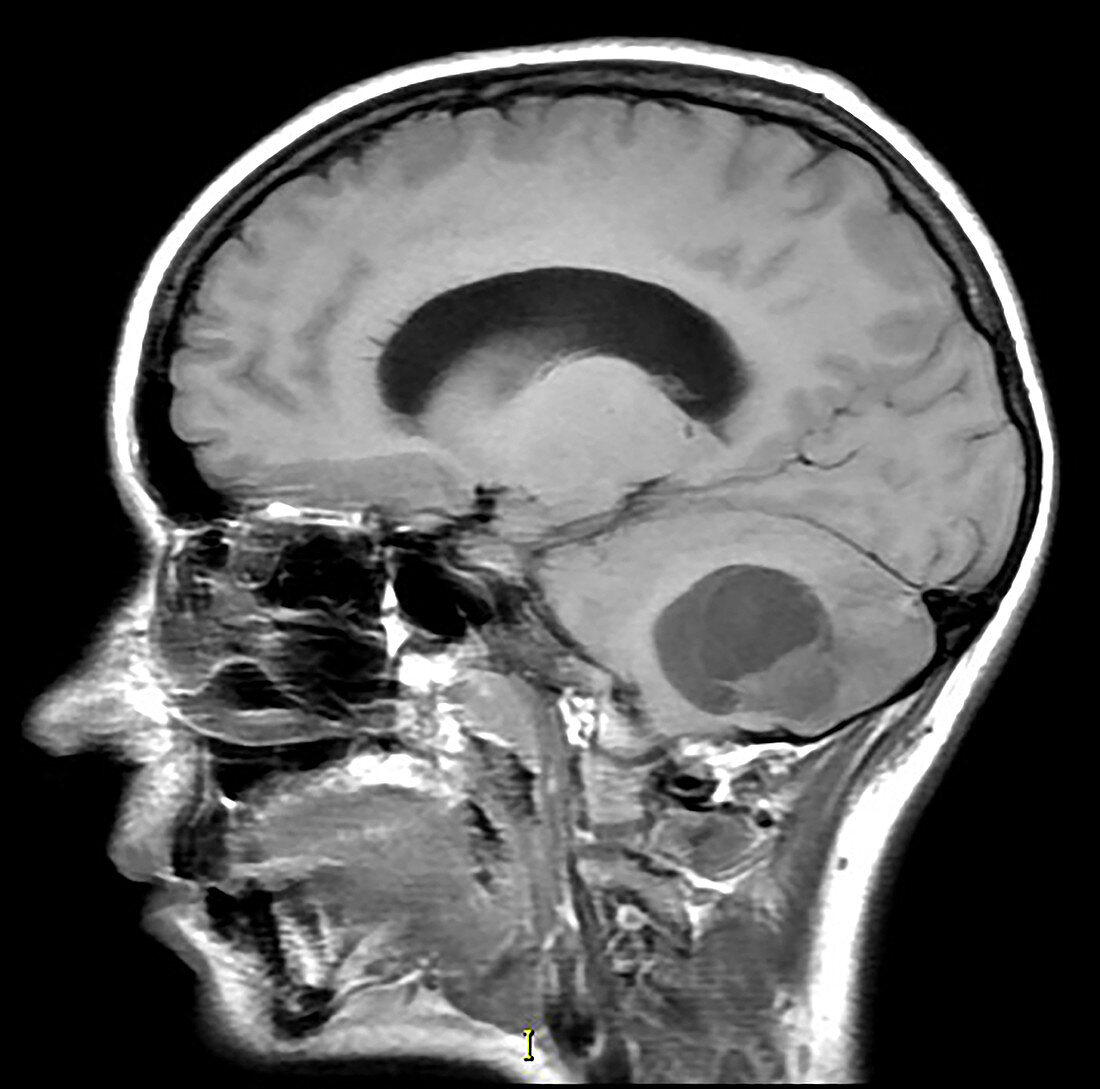 Cerebellar Hemangioblastoma, MRI