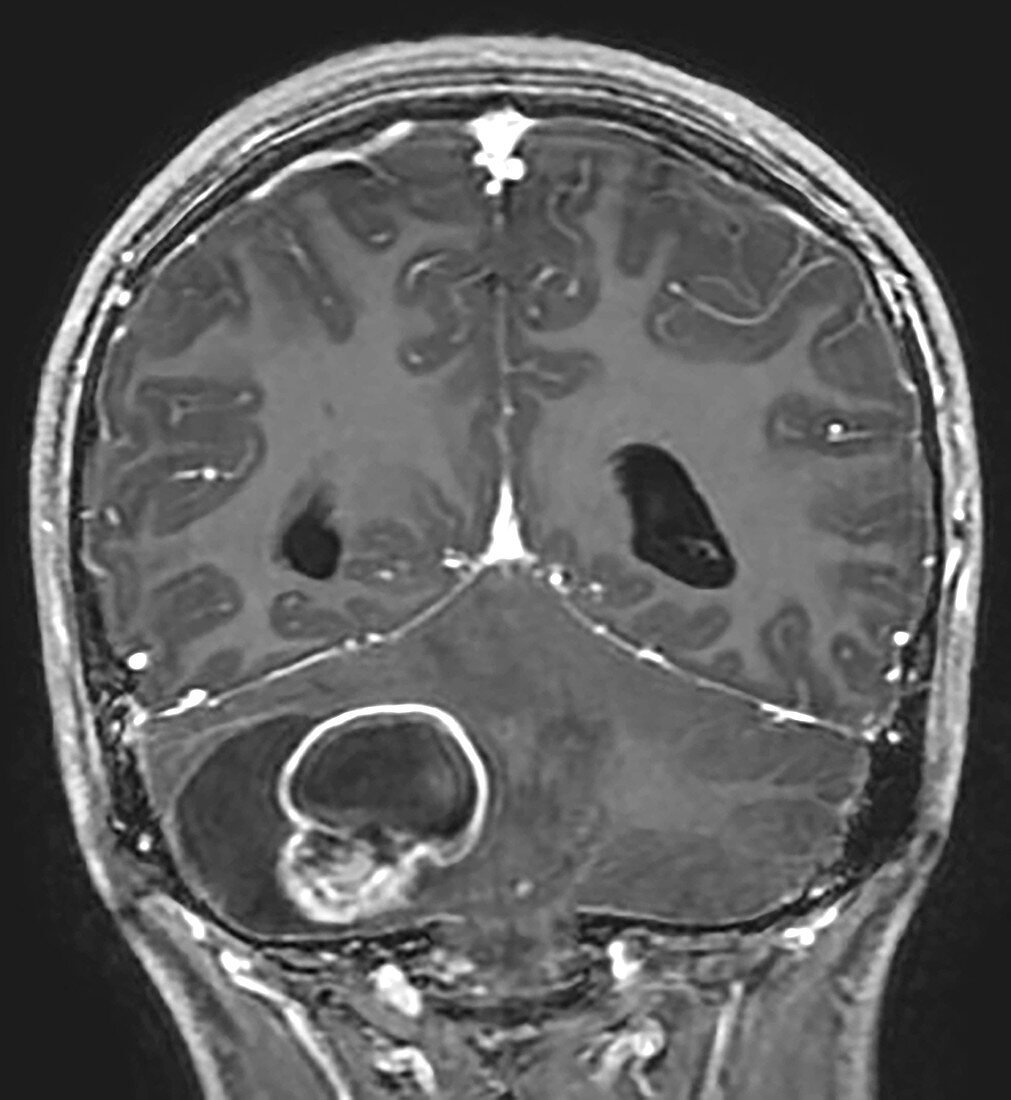 Cerebellar Hemangioblastoma, MRI