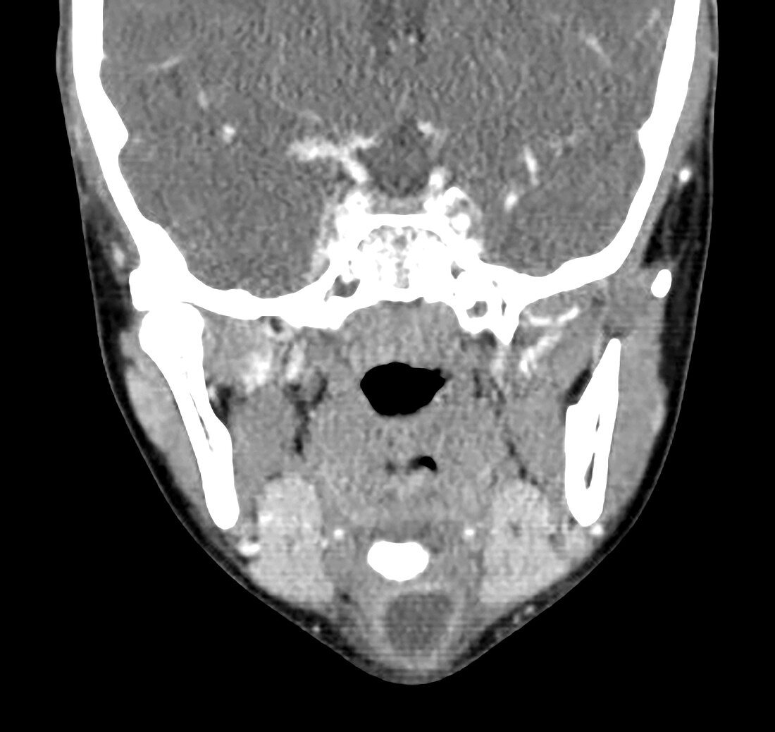 Infected Thyroglossal Duct Cyst, CT scan