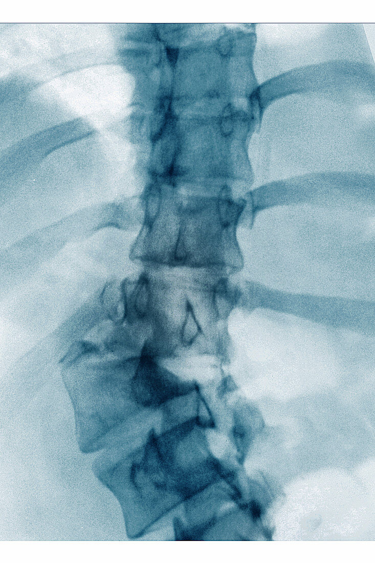 Rotational Dislocation of Scoliosis, X-ray