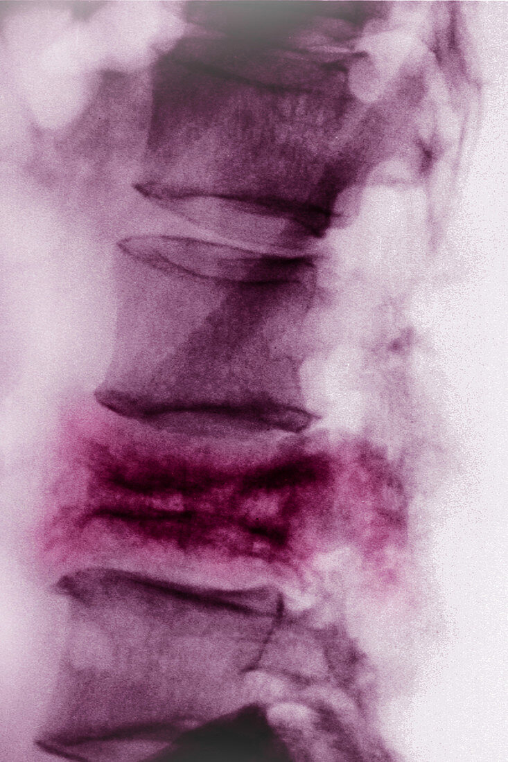 Paget's Disease, X-ray