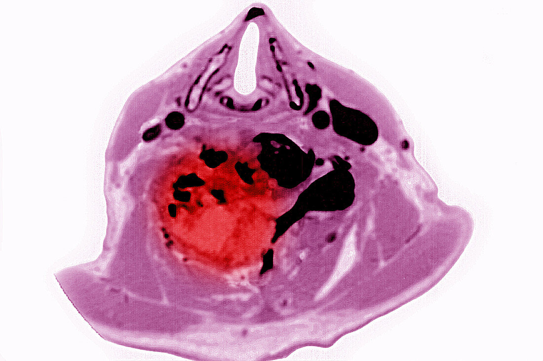 Spinal Tumour, CT Scan