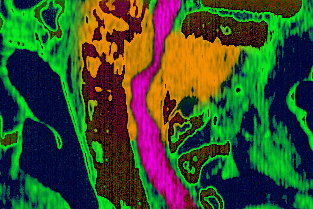 Spinal Tumour, CT Scan