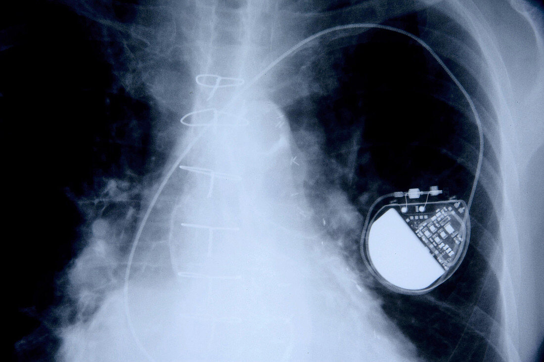 Pacemaker, X-ray