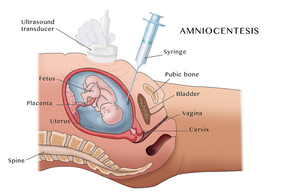 Amniocentesis, Illustration