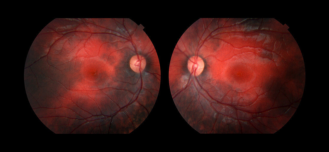 Bilateral Melanosis of Eye