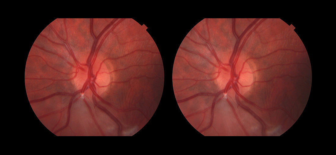 Branch Retinal Artery Occlusion, 1 in 5