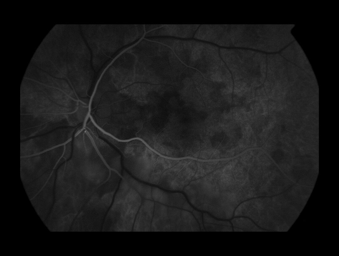 Branch Retinal Artery Occlusion, 2 of 5