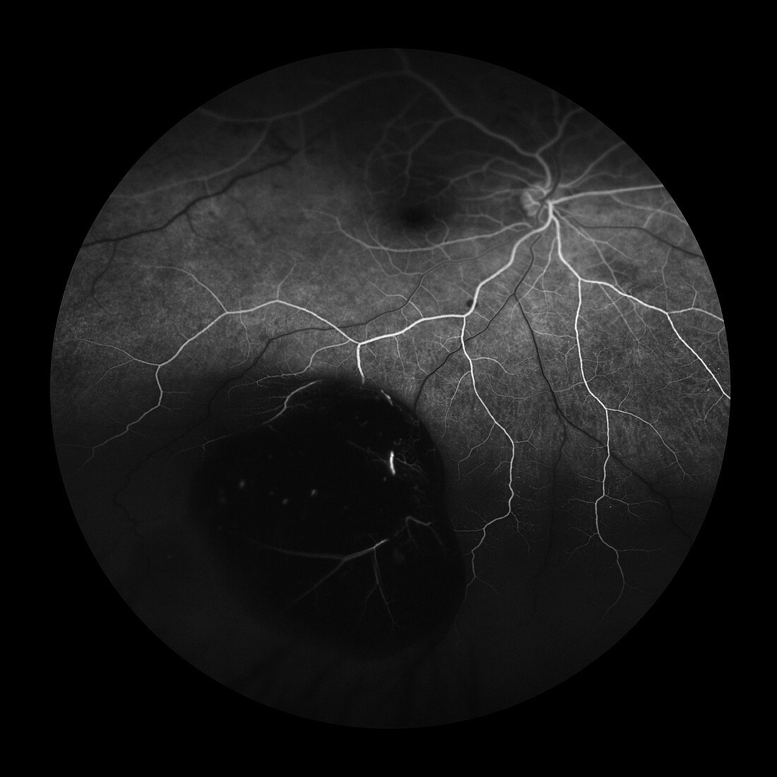 Choroidal Melanoma, 3 of 8