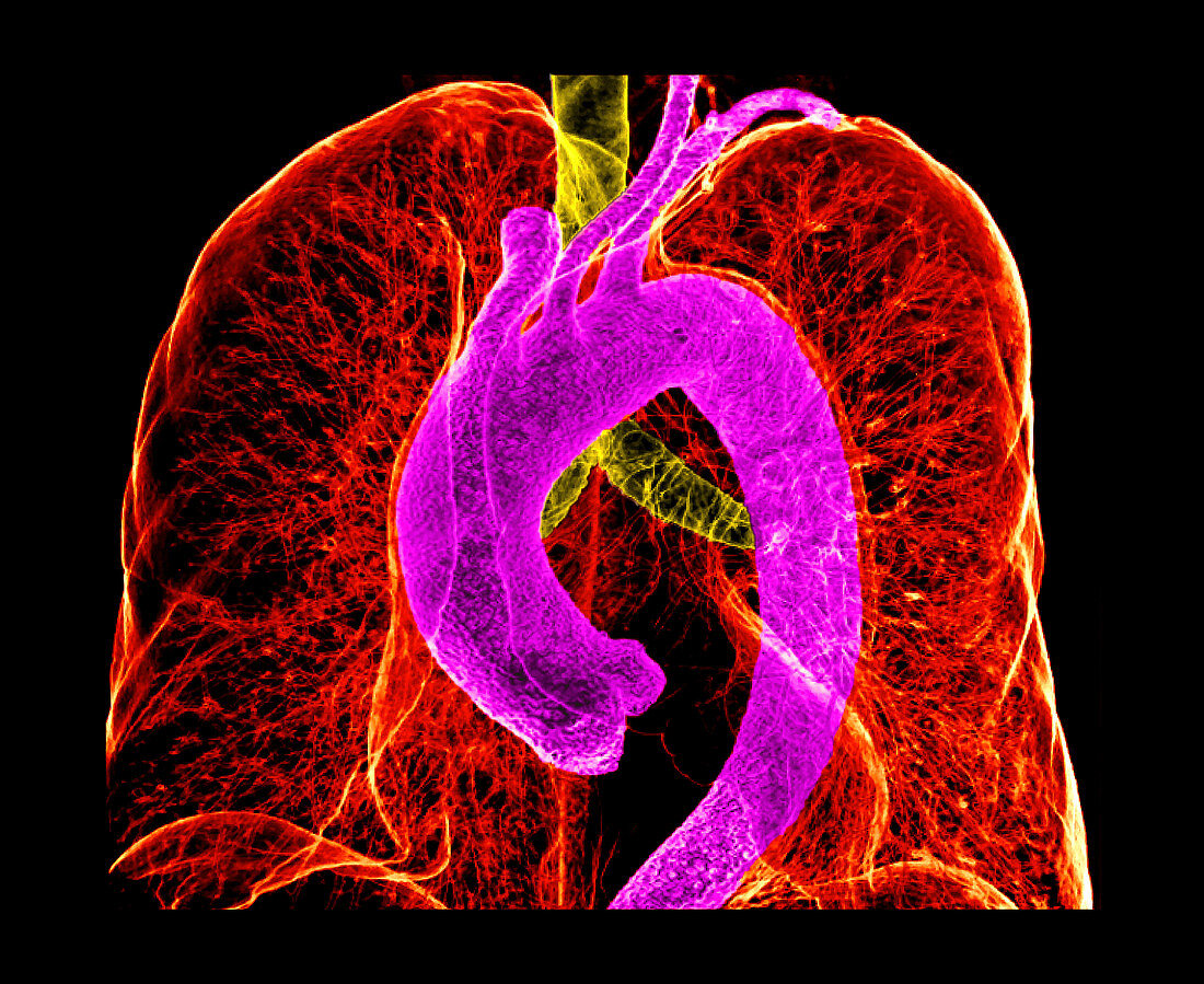 Enhanced Multidetector CT of Chest