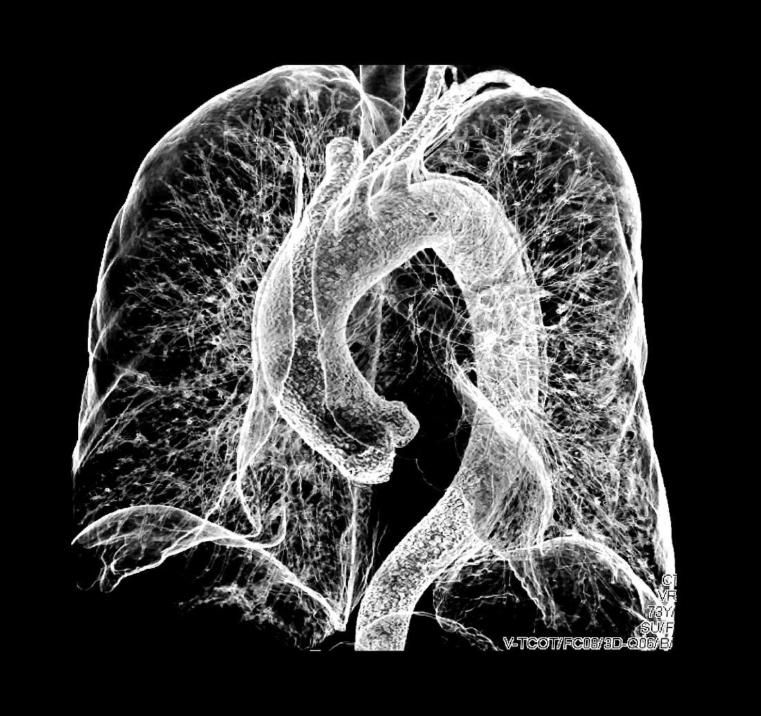 Multidetector CT of Chest