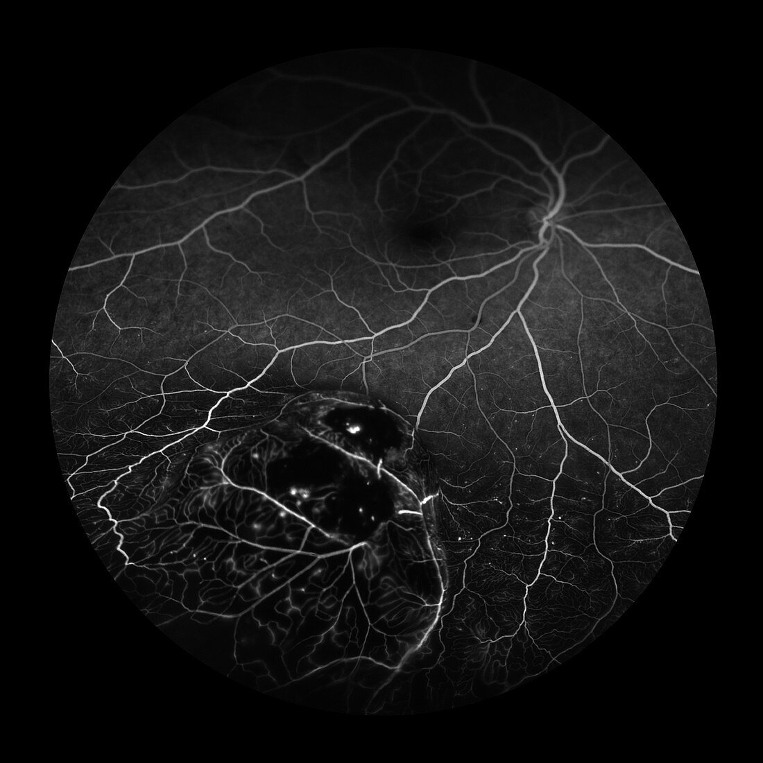 Choroidal Melanoma, 7 of 8