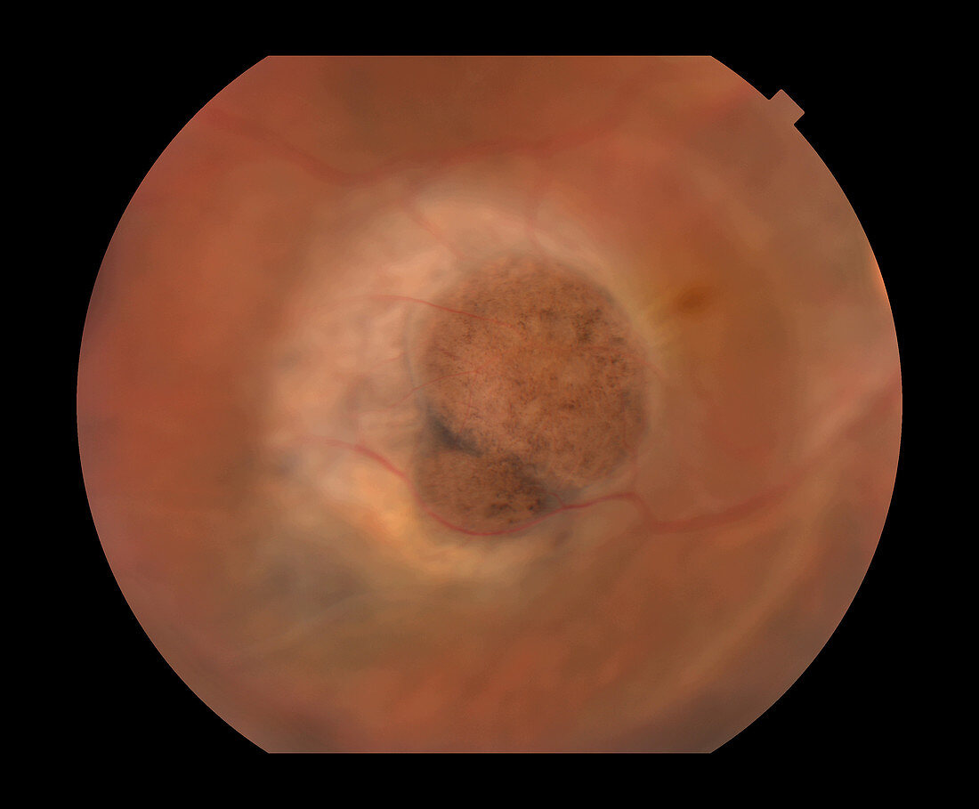 Choroidal Melanoma