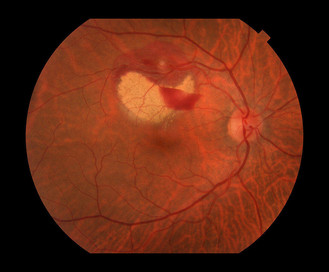 Retinal Artery Macroaneurysm