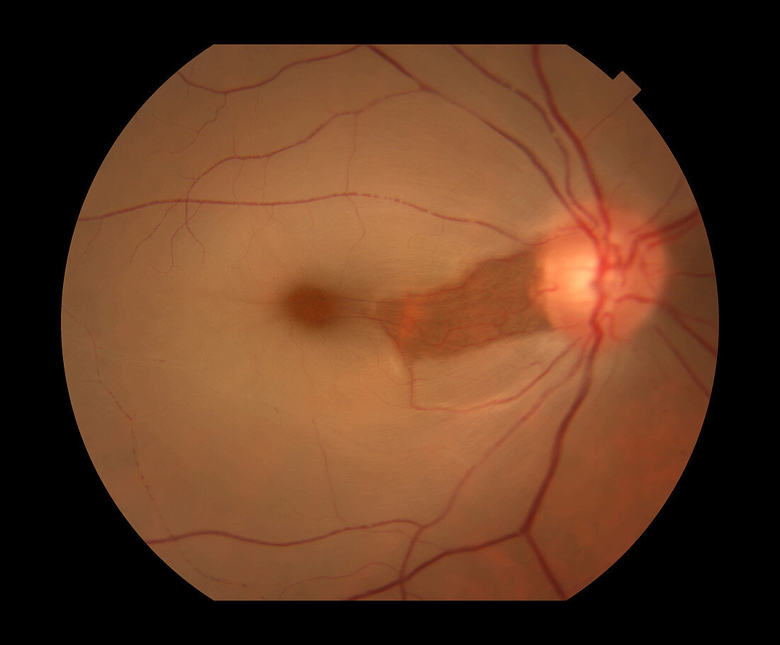 CRAO With Cilioretinal Artery