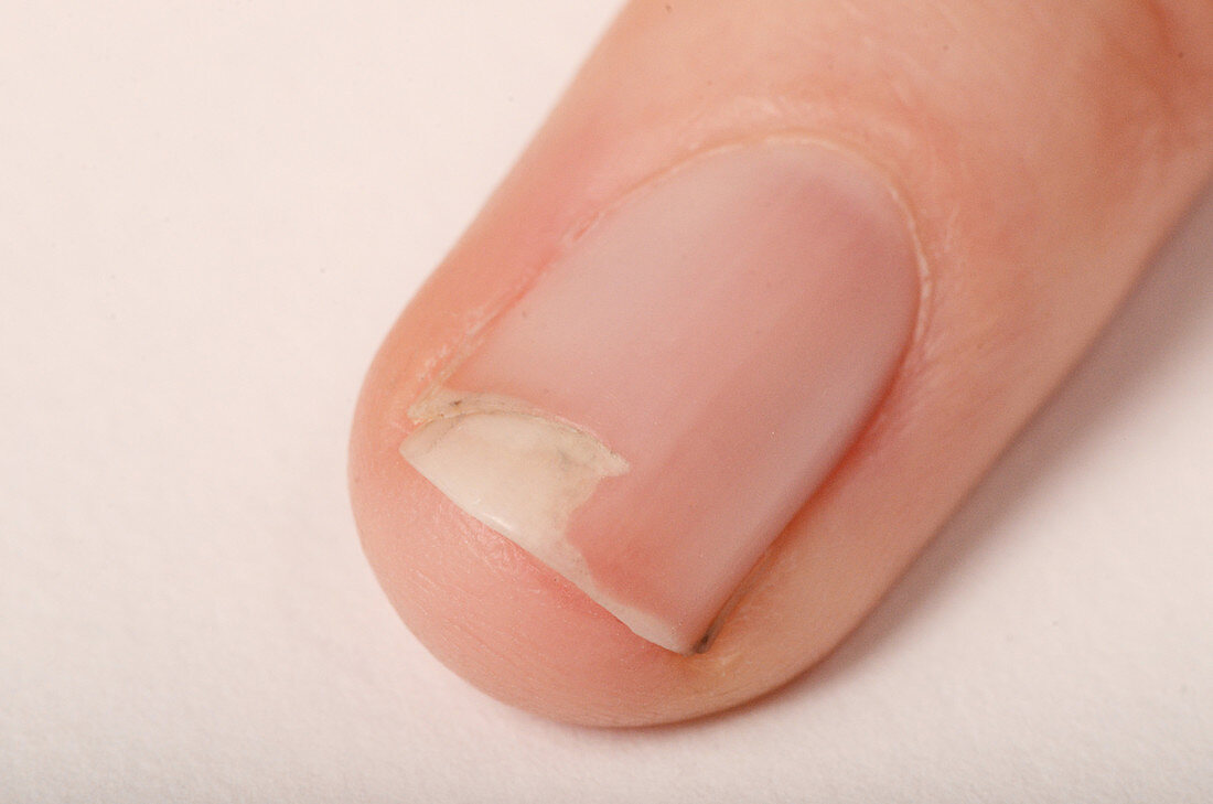 Fingernail Cut
