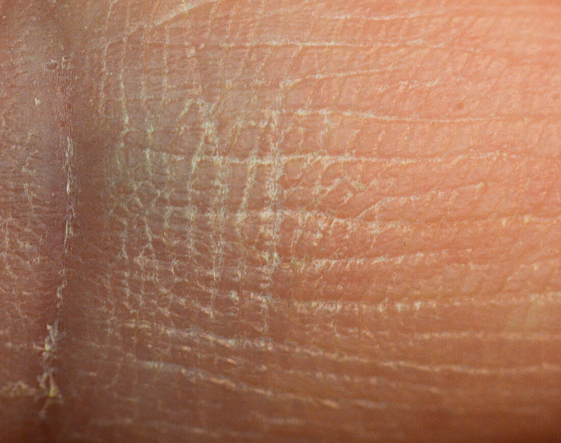 Dry Skin, Close-Up