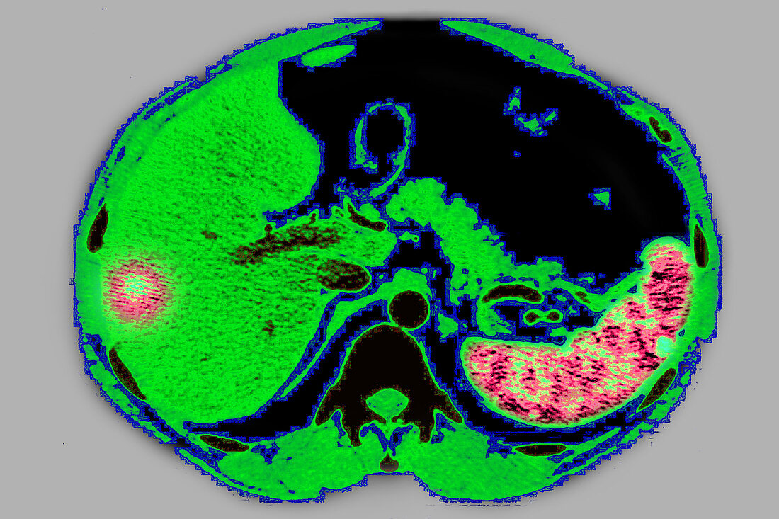 Suppurative Adenopathy, Liver and Spleen, CT Scan