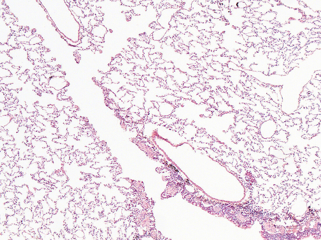 Lung parenchyma, human-A, LM
