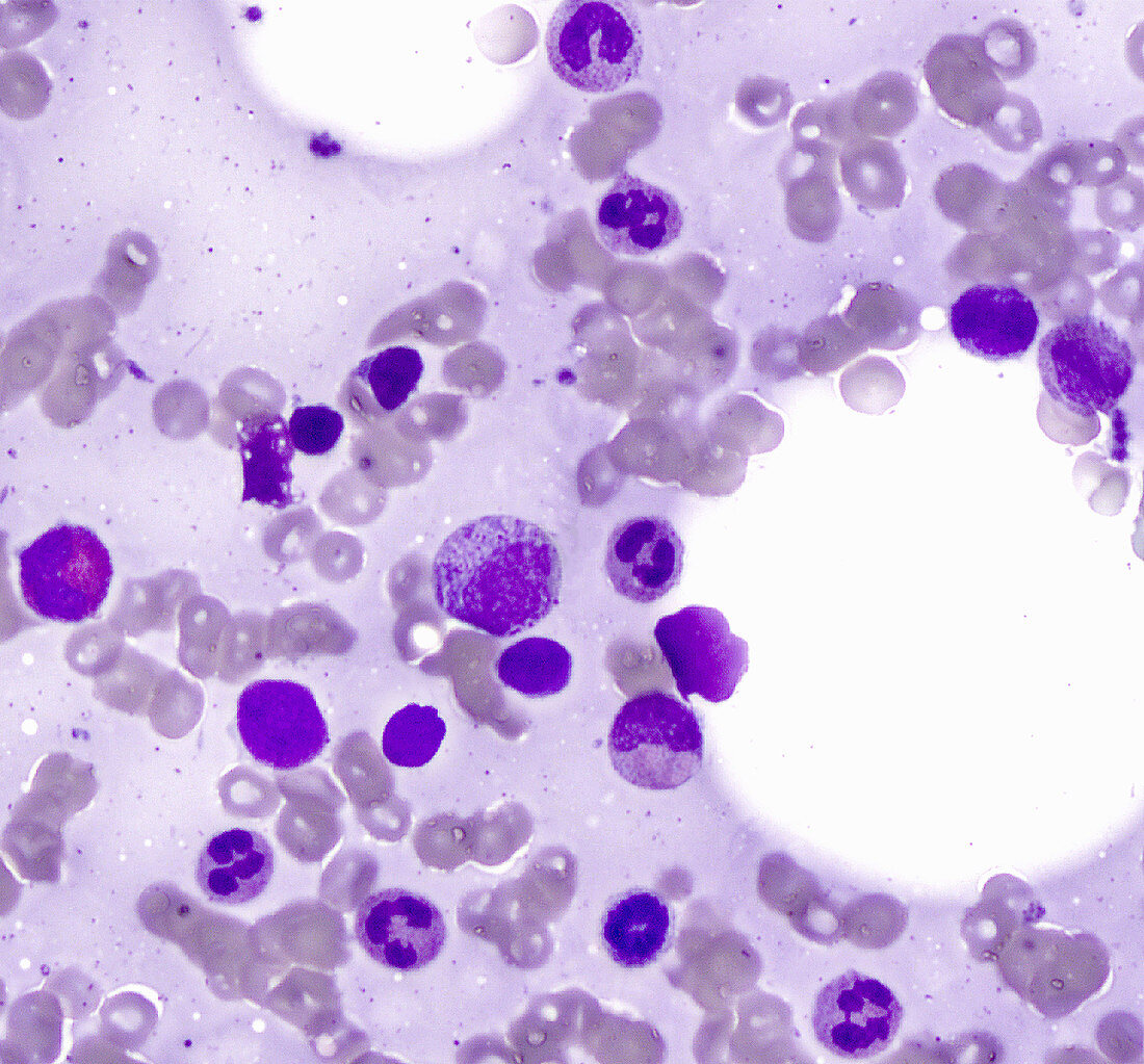 Bone marrow smear, human, LM