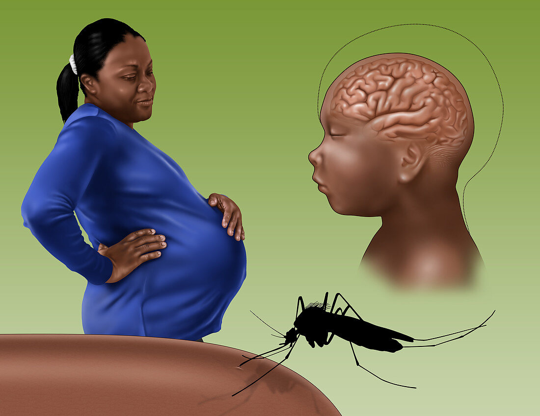 Microcephaly, Zika Virus, Illustration