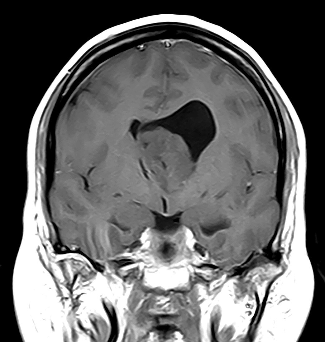 Brain Subependymoma, Coronal T1 weighted MRI