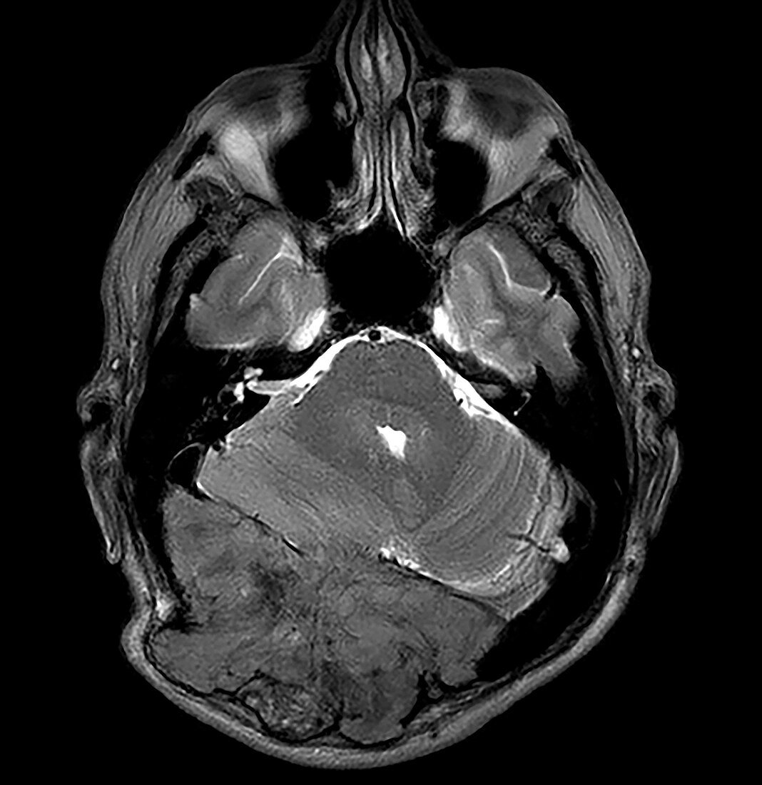 Metastatic Renal Carcinoma to Skull and Brain, MRI