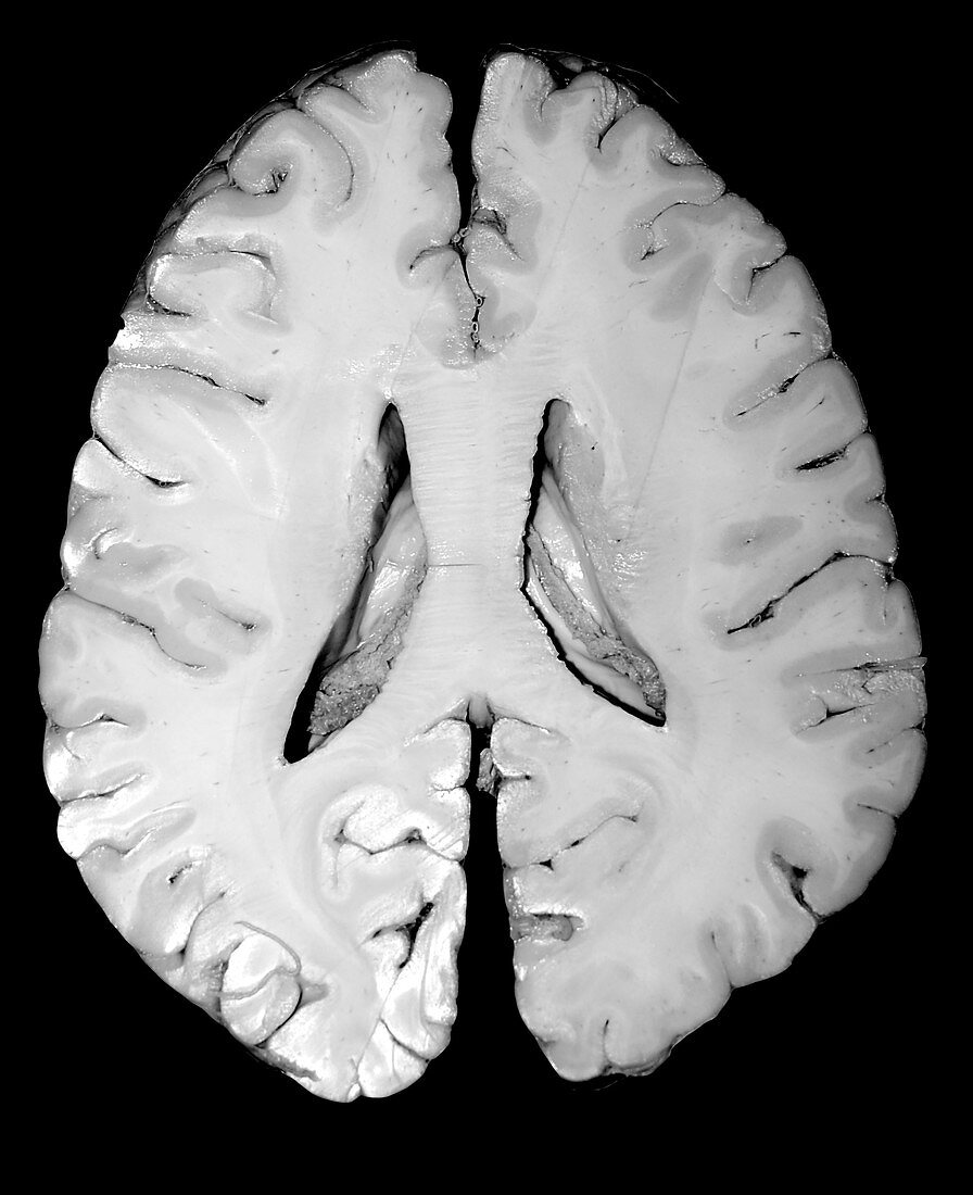 Cadaver Cross Section of Brain