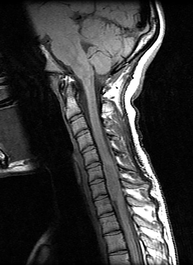 MRI of Cervical Schwannoma