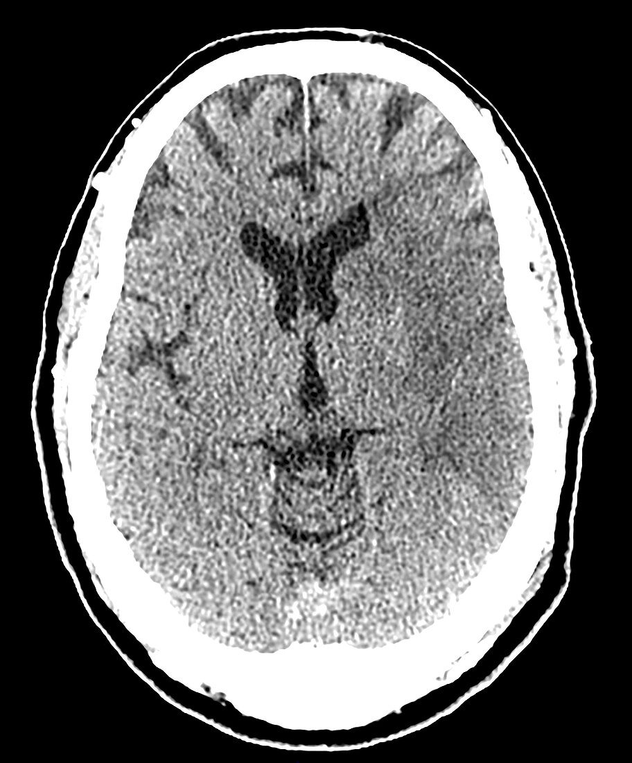 CT of Early Stroke