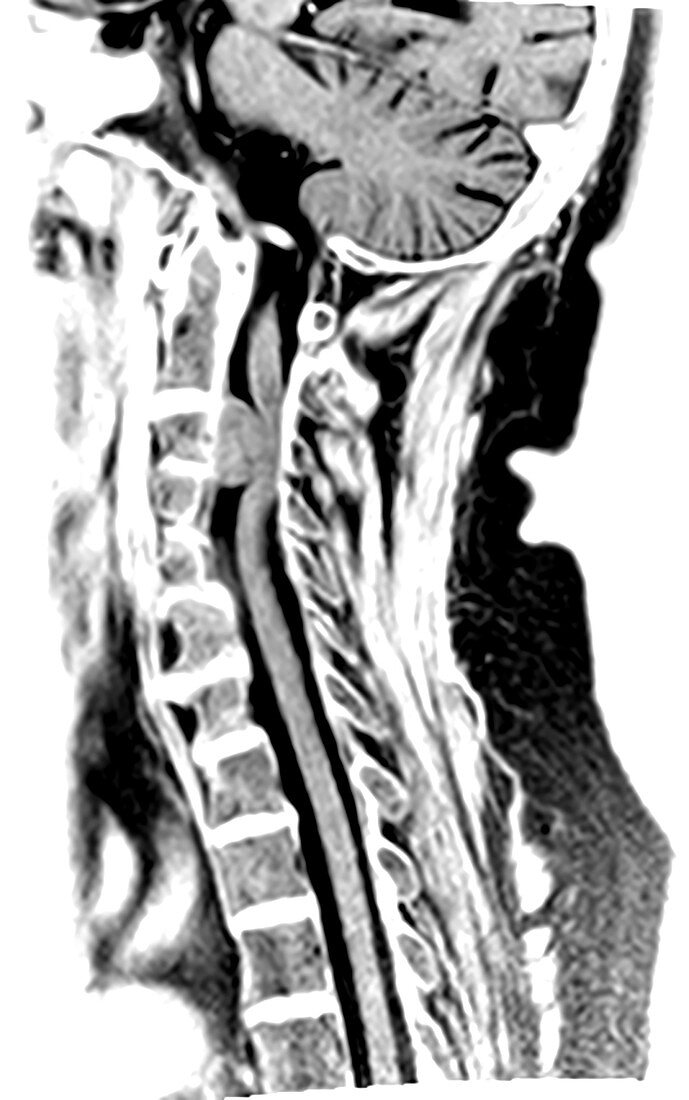 Cervical Spine Meningioma, MRI