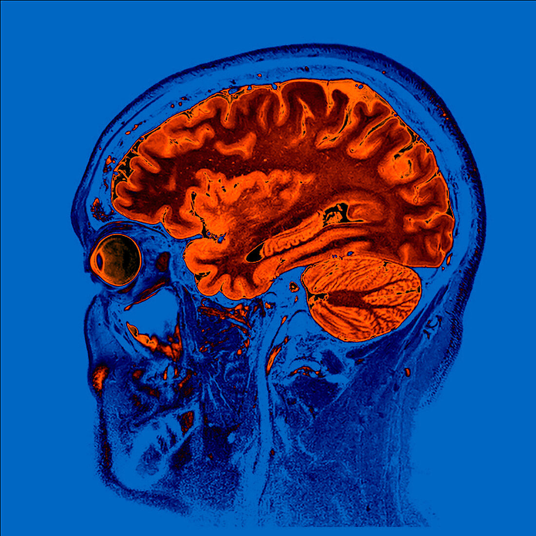 Sagittal Brain MRI