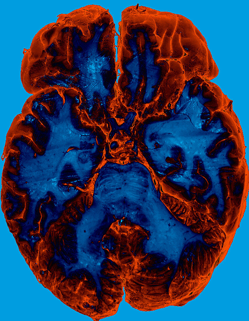 Enhanced Cadaver Brain Section