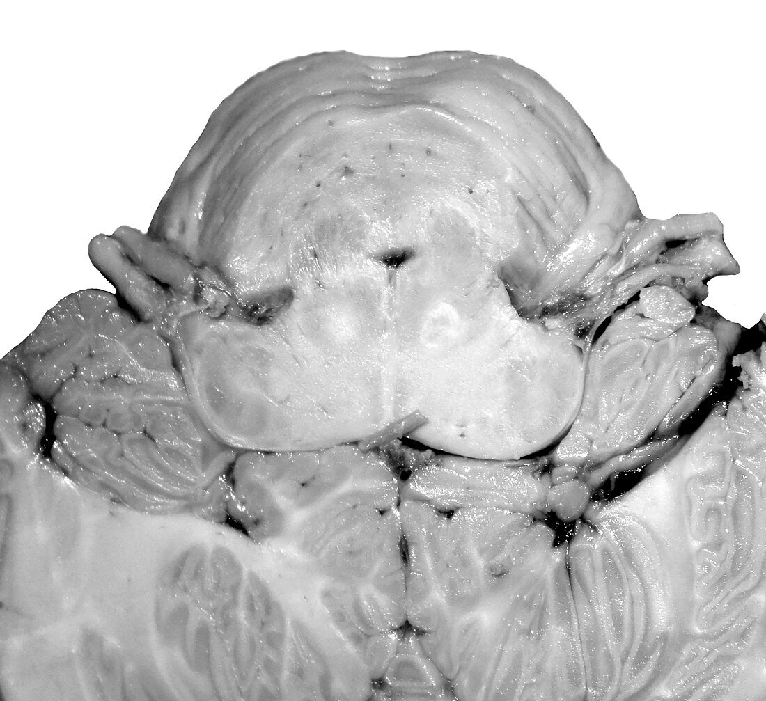 Cadaver Section through Brainstem
