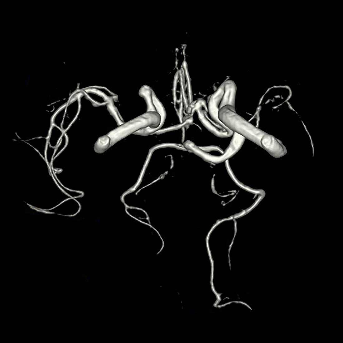 3D MRA of Persistent Trigeminal Artery