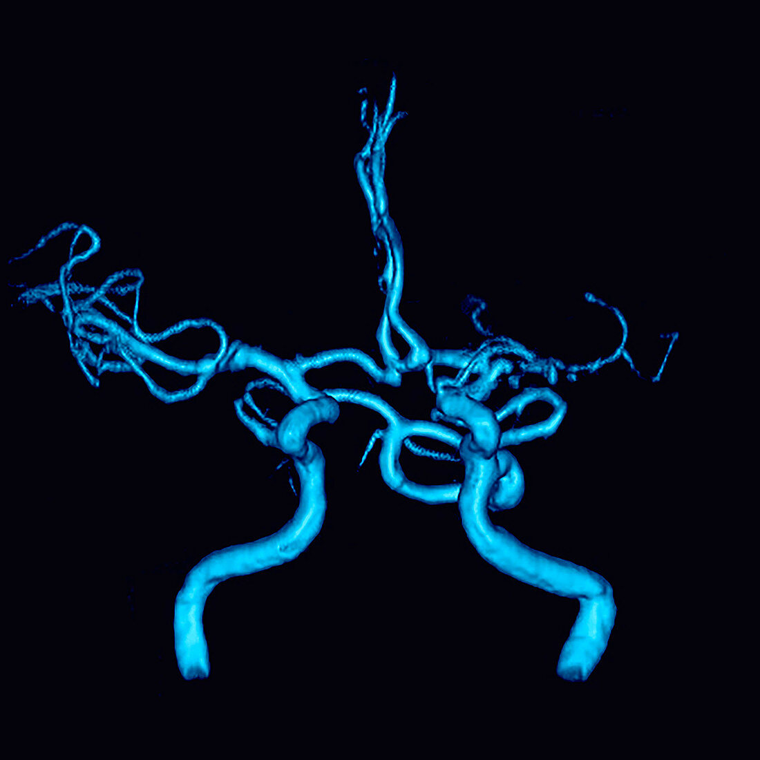3D MRA of Persistent Trigeminal Artery