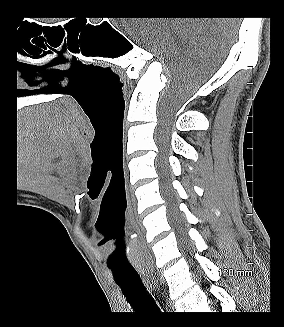 Congenital Assimilation of C1 to Skull Base, CT