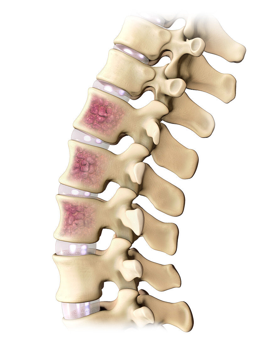 Multiple Myeloma, Spine