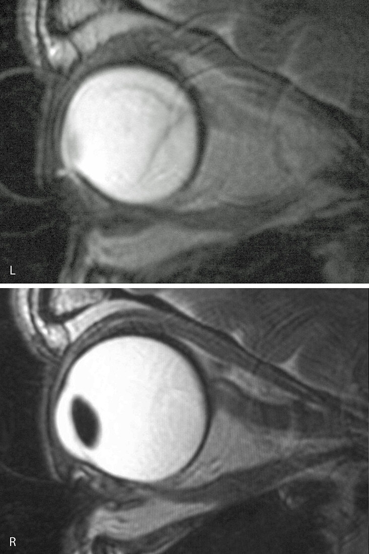 Retinal Detachment, MRI