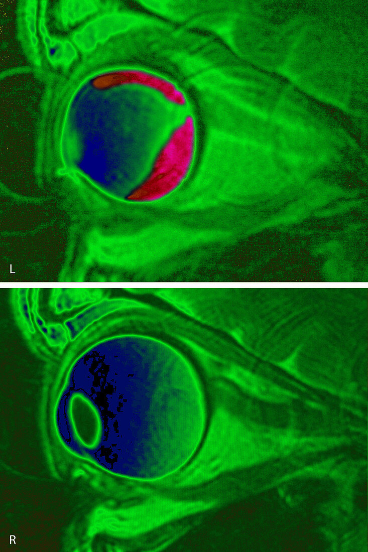 Retinal Detachment, MRI