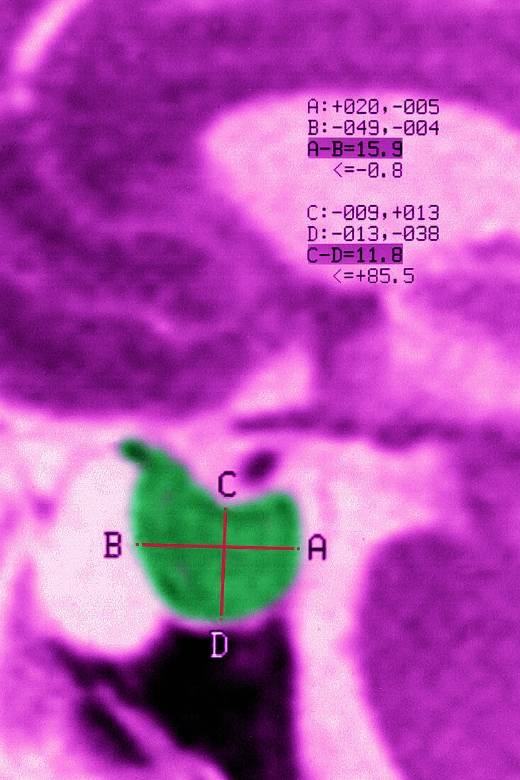 Pituitary Adenoma, MRI