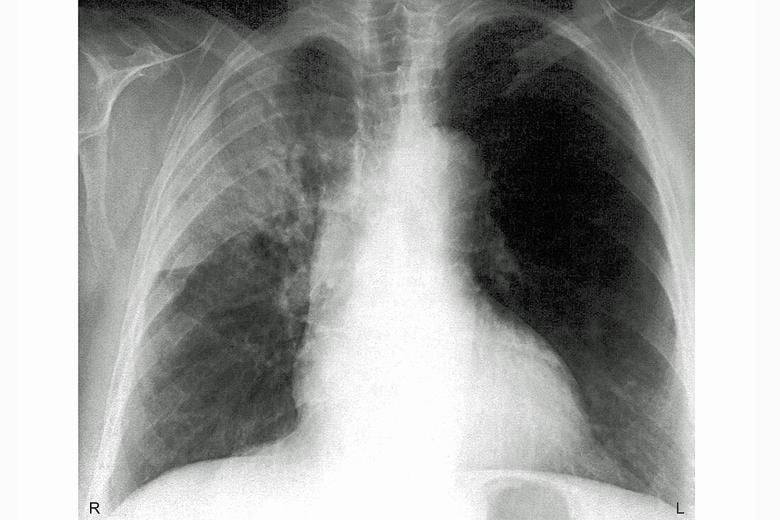 Pneumonia, X-ray