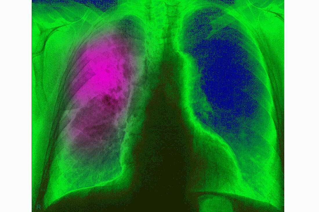 Pneumonia, X-ray